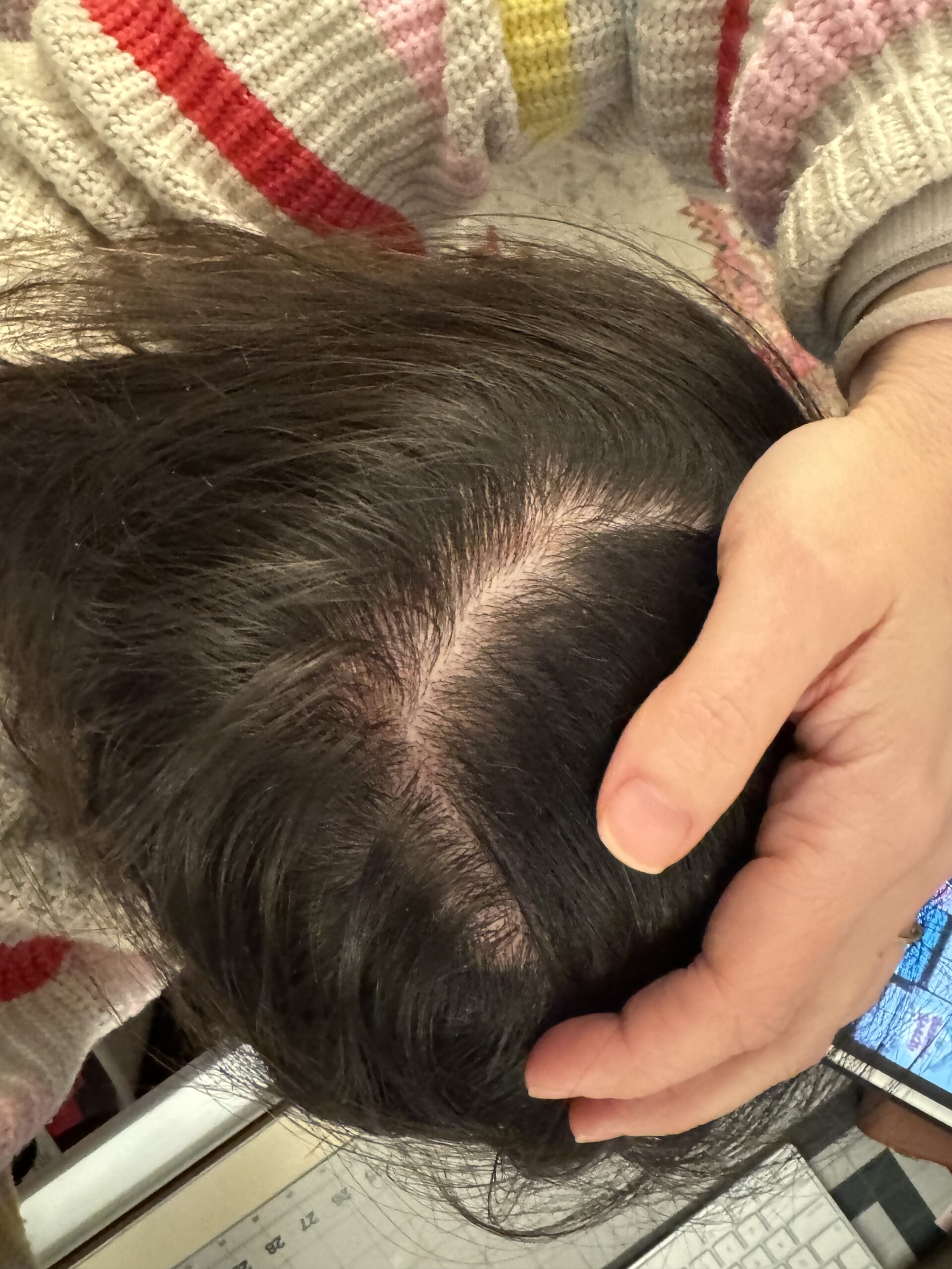 Close-up of a person's head showing a parting in dark hair with visible scalp, hand adjusting the hair, and a blurred background including a smartphone.
